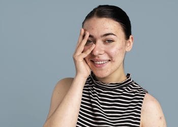 6 Tips Ampuh untuk Mencegah Jerawat Kembali, Biarkan Kulit Anda Tetap Bersih dan Sehat!