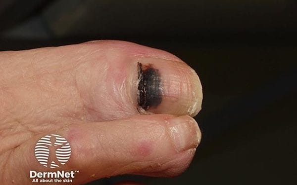 7 Tanda pada Kuku yang Bisa Menandakan Masalah Jantung