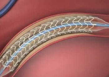 Kapan Pemasangan Ring Jantung Dibutuhkan. Periksa Prosedurnya