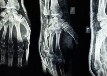 5 Minuman Sehat untuk Tulang yang Bisa Dimulai dari Tegukan Pertama