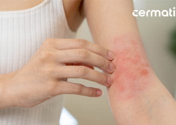 bintik merah di kulit