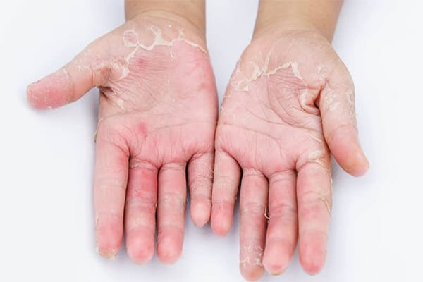 Dermatitis Kontak