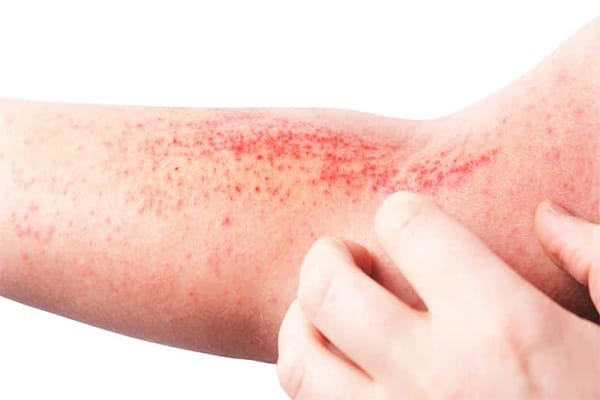 Dermatitis Kontak