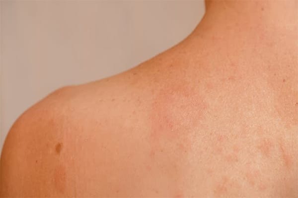 Pityriasis Rosea