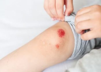 Hidup dengan Hemofilia: Tantangan Pasien di Indonesia